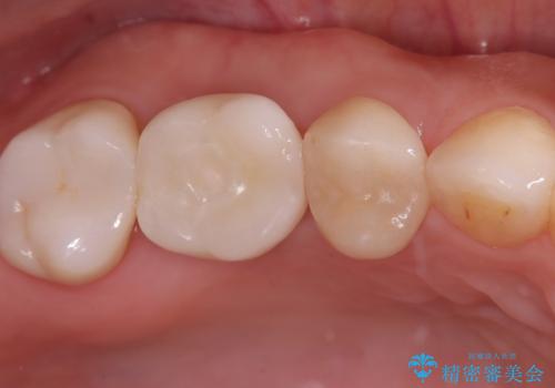 歯のひび割れによる奥歯の痛みも即日解決の治療後