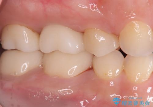 歯の根元の虫歯も精密治療で解決の治療後