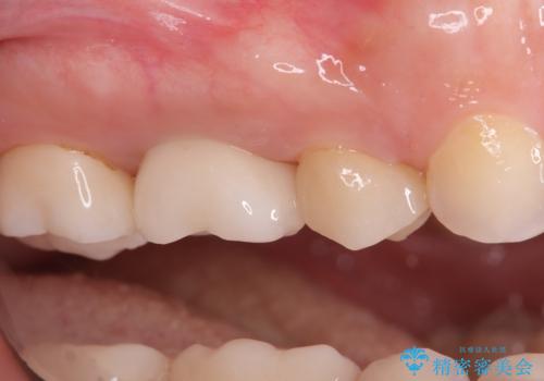 歯のひび割れによる奥歯の痛みも即日解決の治療後