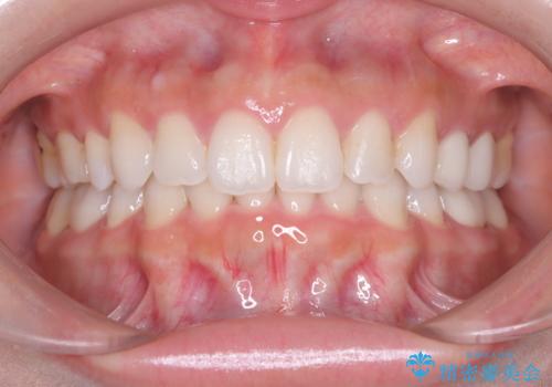 歯の中心のズレを解消し、より美しい口元への症例 治療後