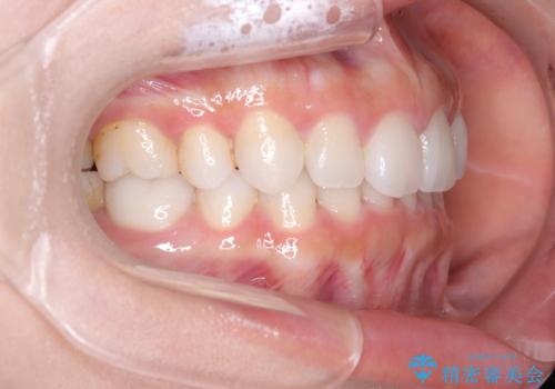 歯の中心のズレを解消し、より美しい口元への治療後