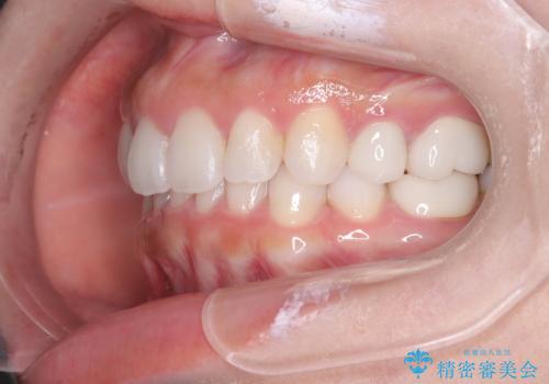 歯の中心のズレを解消し、より美しい口元への治療後