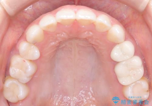 歯の中心のズレを解消し、より美しい口元への治療後
