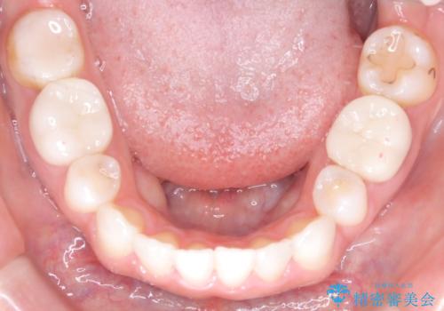 歯の中心のズレを解消し、より美しい口元への治療後