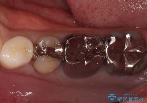 神経を抜かずに深い虫歯を治療の症例 治療後