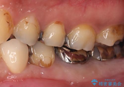 神経を抜かずに深い虫歯を治療の治療後