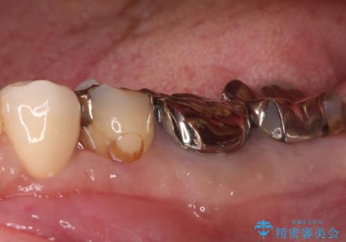 神経を抜かずに深い虫歯を治療の治療後