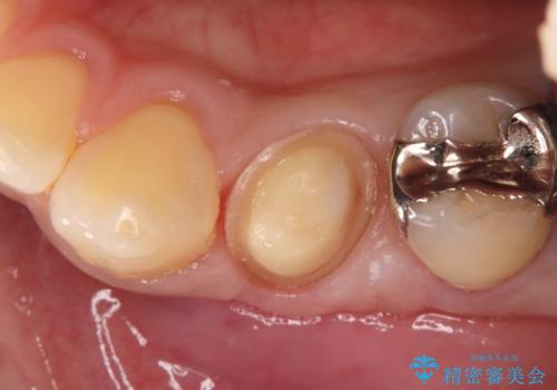 神経を抜かずに深い虫歯を治療の治療中