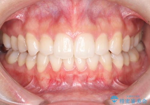 目立たない矯正で歯のデコボコと反対咬合を改善の症例 治療後