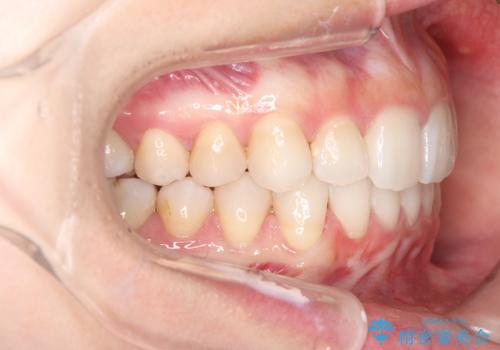 目立たない矯正で歯のデコボコと反対咬合を改善の治療後