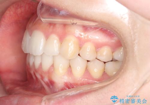 目立たない矯正で歯のデコボコと反対咬合を改善の治療後