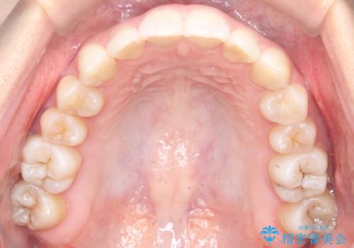 目立たない矯正で歯のデコボコと反対咬合を改善の治療後