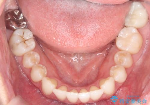 目立たない矯正で歯のデコボコと反対咬合を改善の治療後