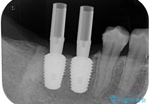 挺出歯を圧下してスペースを確保!目立たない部分矯正で下顎大臼歯にインプラント治療を実現の治療中