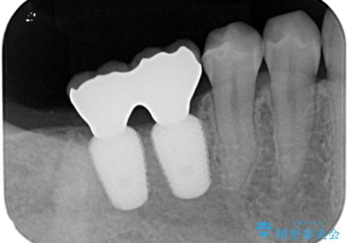 挺出歯を圧下してスペースを確保!目立たない部分矯正で下顎大臼歯にインプラント治療を実現の治療後