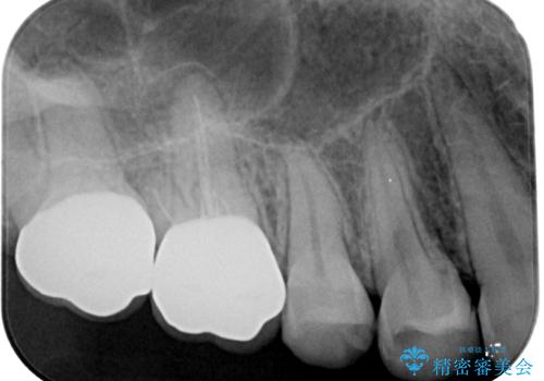挺出歯を圧下してスペースを確保!目立たない部分矯正で下顎大臼歯にインプラント治療を実現の治療後