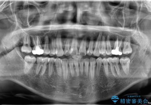 1年でここまで変わる!歯列のがたつきと正中のズレを改善した矯正治療(メタルブラケット×MARPE)の治療後