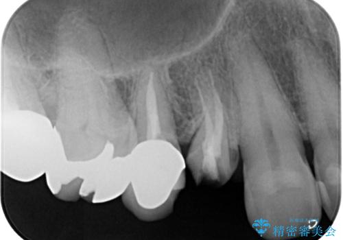 自然な美しさと強度を両立!右上小臼歯の被せもの脱離に対する審美補綴治療の治療前
