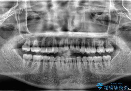 目立たないマウスピース矯正で下の前歯のデコボコをスッキリ解消!たった1年で整った歯並びにの治療後