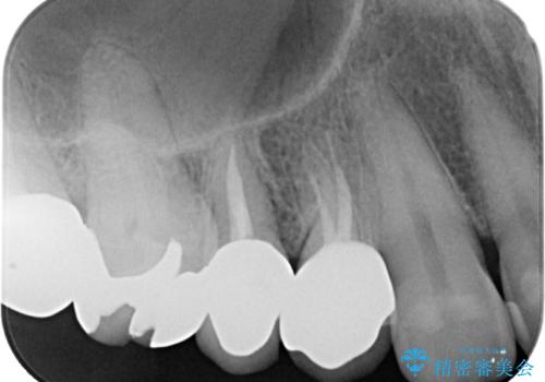 自然な美しさと強度を両立!右上小臼歯の被せもの脱離に対する審美補綴治療の治療後