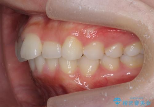 前歯のがたつき気になる。インビザラインモデレートの治療前