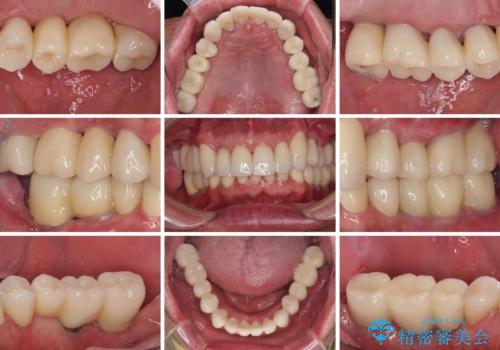 強い咬合力で奥歯がボロボロに インプラント治療による咬合回復と全顎セラミック治療の治療後