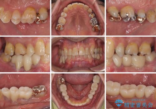 奥歯の欠損と前歯のデコボコを治したい インプラントと矯正治療の総合歯科治療の治療後