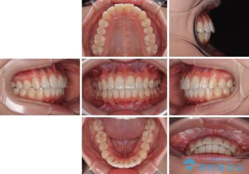 深い咬み合わせによる隙間 インビザライン矯正でコンプレックスを改善の治療後