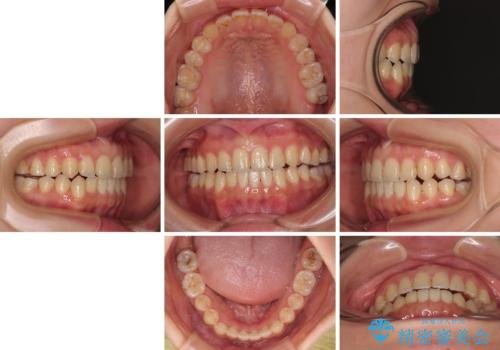 前歯のオープンバイト インビザラインで咬み合わせを改善の治療後