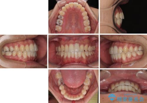 気になる前歯のデコボコと八重歯 ワイヤー矯正ですっきりとの治療後