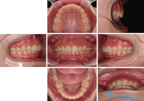 骨格的な出っ歯を抜歯矯正で改善 横顔の印象が劇的に変化の治療後