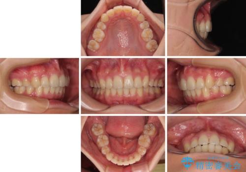 全顎的なデコボコと口元の突出感 ワイヤー装置での抜歯矯正で整った口元にの治療後