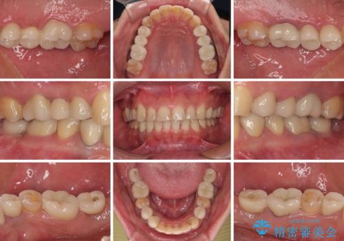 銀歯を白くしたい 一緒に矯正治療も行ない美しい口腔内にの治療後