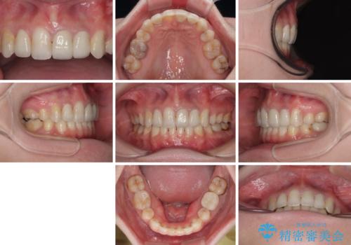 気になっていたむし歯と前歯のデコボコ 矯正治療とむし歯治療の総合歯科治療の治療後