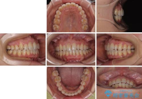 骨格的なズレを歯列矯正でカバー ワイヤー装置での非抜歯矯正の治療後