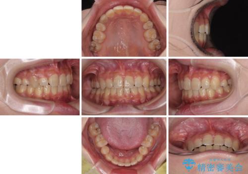 気になる八重歯 ワイヤー装置での抜歯矯正の治療後