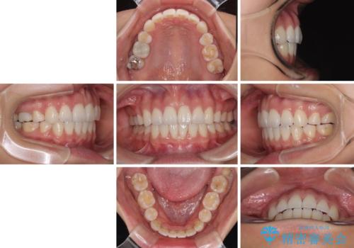 唇を閉じて眠れない ワイヤー装置での抜歯矯正で口元をスッキリとの治療後