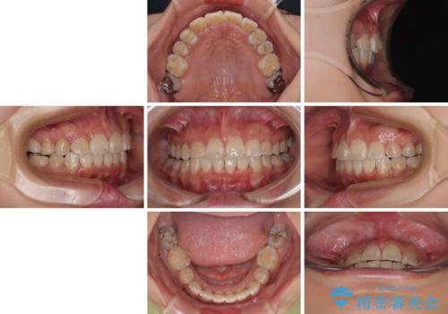 永久歯が埋もれて乳歯が残存 叢生改善のワイヤー抜歯矯正の治療後