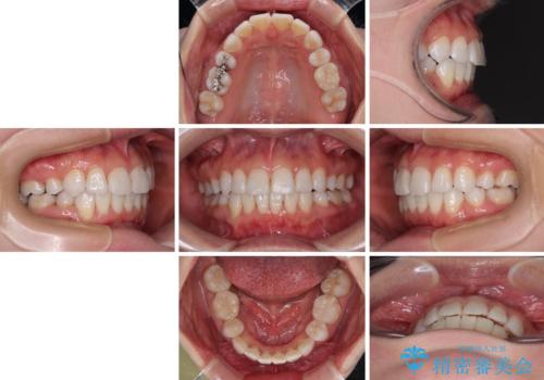 矯正治療の後戻り インビザラインで短期間矯正治療の治療後