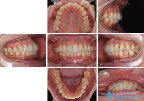 デコボコと乳歯の欠損 ワイヤー矯正とインプラント補綴治療の治療後