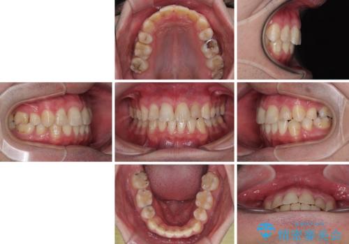 【モニター】出っ歯と奥歯の咬み合わせを改善 補助装置を用いたワイヤー抜歯矯正の治療後