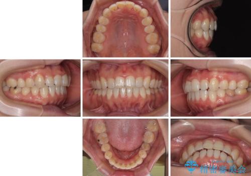 【モニター】飛び出した上顎前歯 補助装置を併用したインビザライン矯正治療の治療後