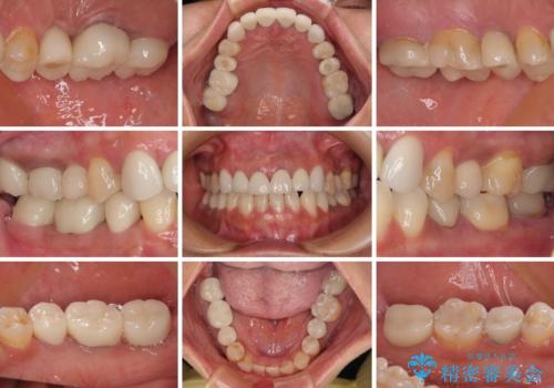 新幹線通院 地元で断られた奥歯のむし歯治療の治療後