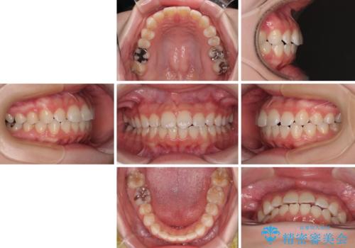 気になる前歯を矯正 短期間のワイヤー矯正治療の治療後