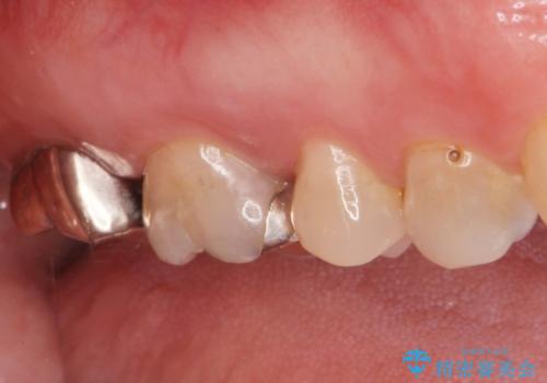 右奥歯治療が必要と言われた。の治療前