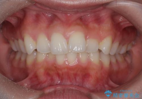 前歯のがたつき気になる。インビザラインモデレートの治療前