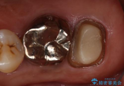 奥歯が取れた フルジルコニアクラウンの治療中