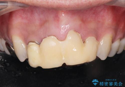 前歯ブリッジの症例 治療前