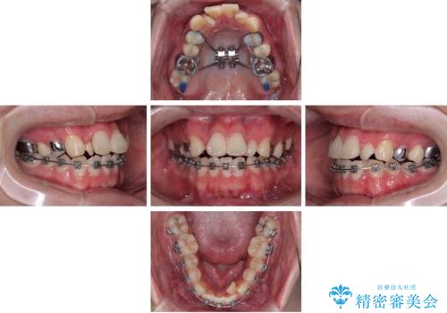 1年でここまで変わる!歯列のがたつきと正中のズレを改善した矯正治療(メタルブラケット×MARPE)の治療中