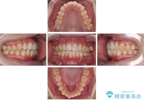 目立たないマウスピース矯正で下の前歯のデコボコをスッキリ解消!たった1年で整った歯並びにの治療中